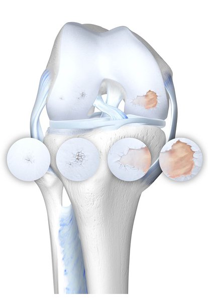 ORTHO-TEAM Arthrose Knieskelett