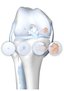 ORTHO-TEAM Arthrose Knieskelett