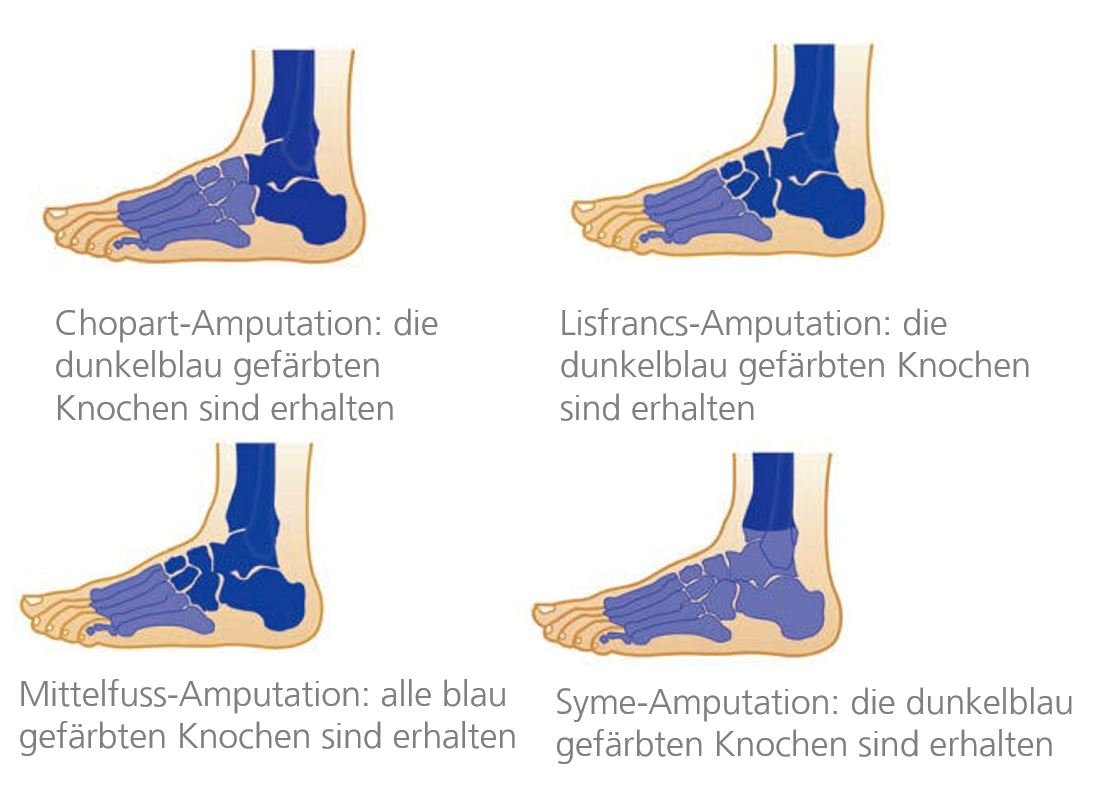ORTHO-TEAM Fussprothesen Fussamputationen